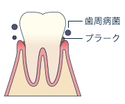 軽度の歯周炎（P1）